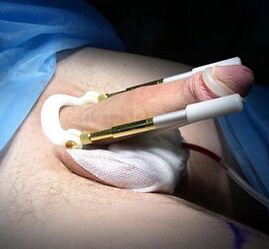 Comment se déroule la chirurgie d’agrandissement du pénis